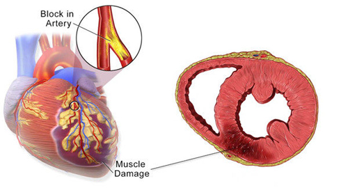 О инфаркте миокарда